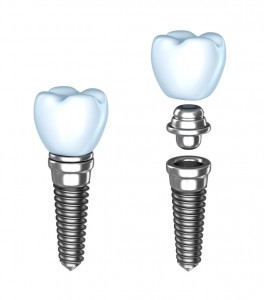 Denver dental implants